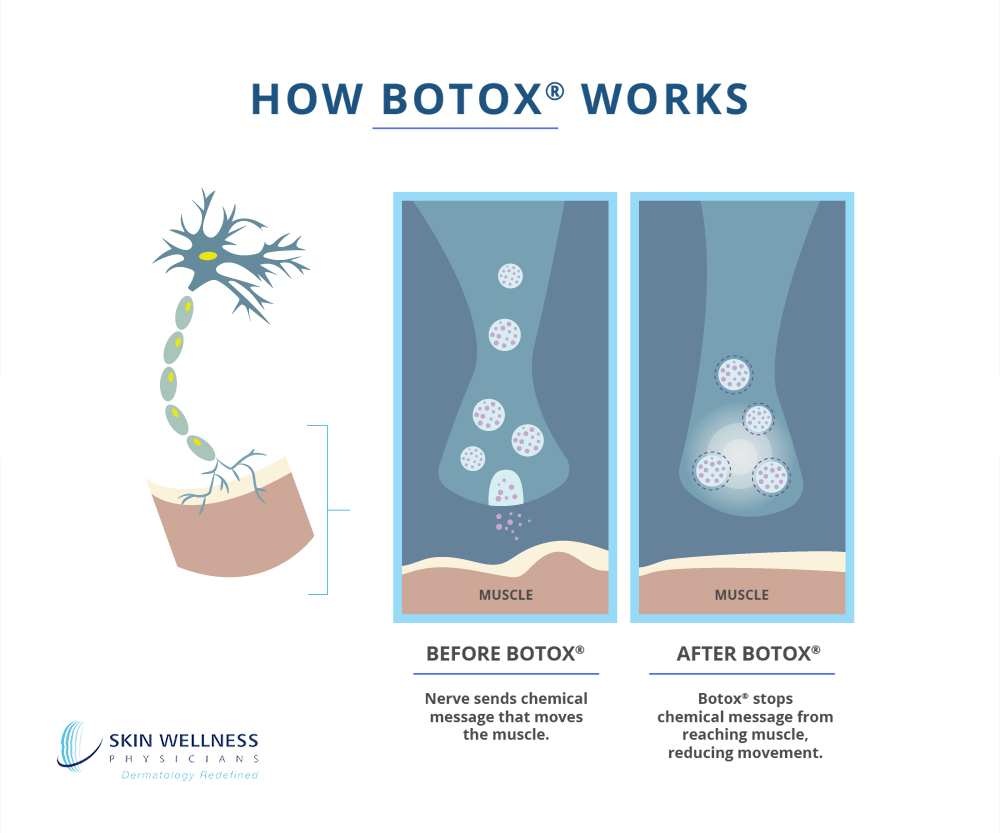 Get an 'inside look' at how we use BOTOX® at Florida's Skin Wellness Physicians to reduce muscle activity—and wrinkles—on the face.