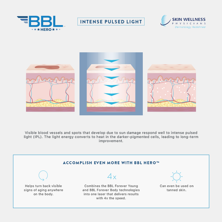 Discover how IPL with BBL Hero works to treat visible vessels and sun-damage spots in the skin at Skin Wellness Physicians.